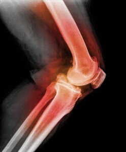 Lär dig allt om dislokation av knäskålen