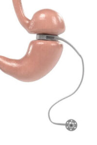 Fetmaoperation med gastriskt band