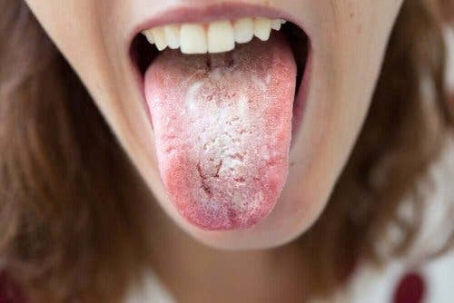 Mörka fläckar på tungan: kvinna med svamp på tungan