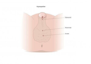 Symptom och behandling av hypospadi