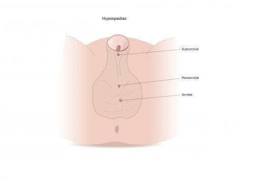 Symptom och behandling av hypospadi