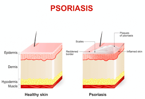 illustration av psoriasis