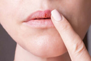 Herpes simplex-virus och deras egenskaper