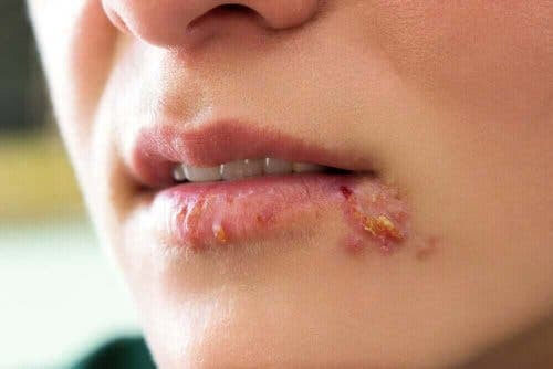 munsår från herpes simplex-virus