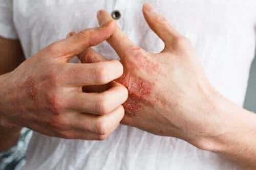 Vad är hudsjukdomen atopisk dermatit?
