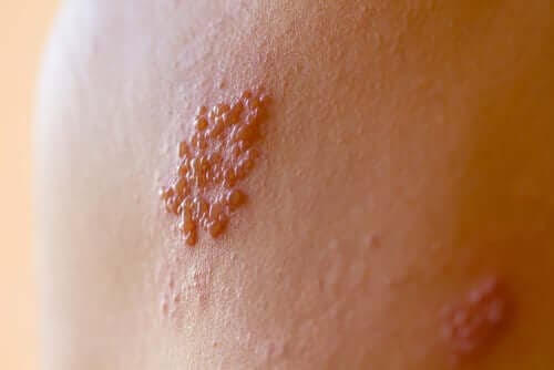 sår från herpes simplex-virus