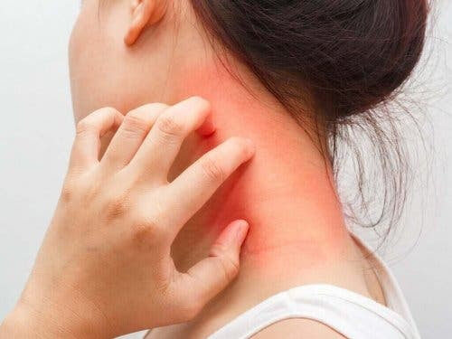 kvinna med hudsjukdomen atopisk dermatit: river sig på nacken