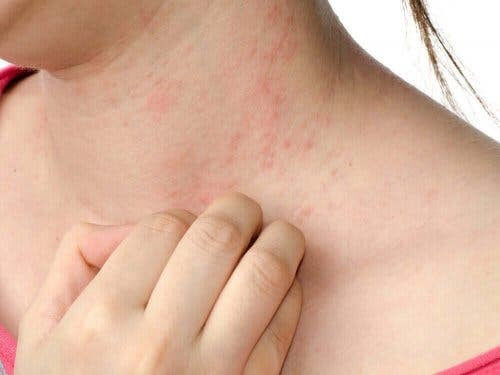 person med hudsjukdomen atopisk dermatit kliar sig på halsen