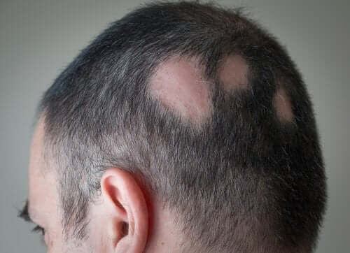 Minoxidil: man med kala fläckar på huvudet