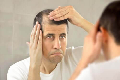 Minoxidil: man med kala fläckar på huvudet tittar sig i spegeln