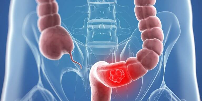 Illustration av blockering i tjocktarmen.