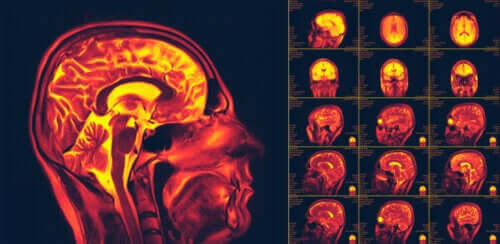 Vad är hjärnans neuroplasticitet? Förmågan till förändring