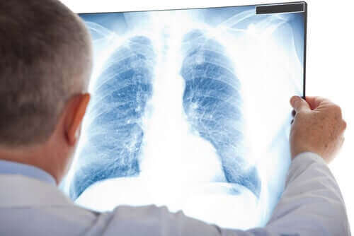 Läkare tittar på en röntgenbild av en bröstkorg.