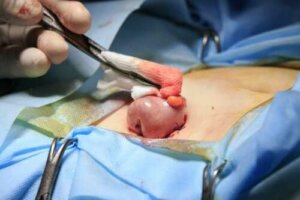 Allt om kolostomi - orsaker, tekniker och komplikationer