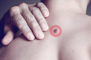 Orsaken till varför man får fettknölar på ryggen