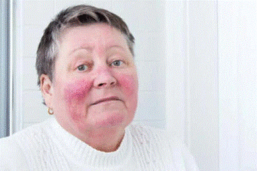 Hudsjukdomen rosacea - orsaker och symptom