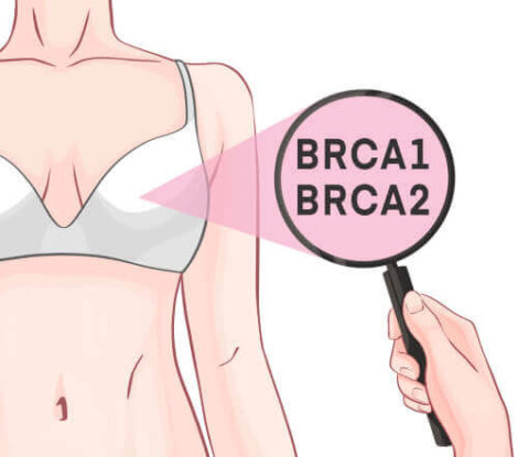 Generna BRCA1 och BRCA2 och bröstcancer