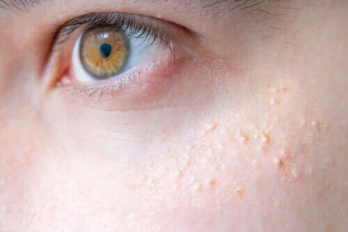 Keratosis pilaris och naturläkemedel