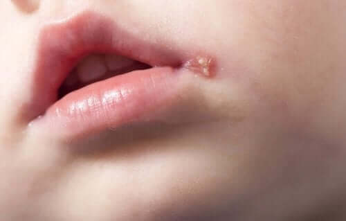 Hur behandlar man munsår: En närbild på en person med herpes.