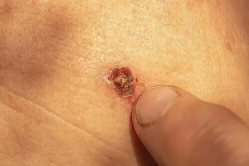 Vårta på en kropp.