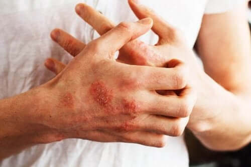 Sarsaparill kan användas mot sår på händerna.