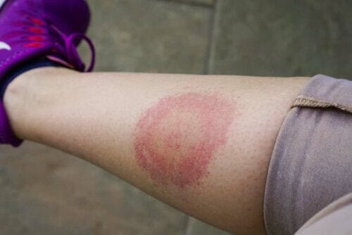 behandling av borreliainfektion