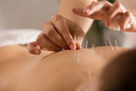 Dry needling: en person utför akupunktur.