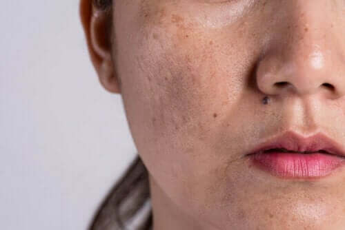 Kvinna med hudfläckar i ansiktet.