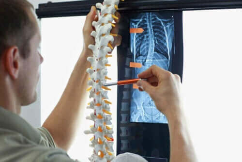 Skolios hos barn: Läkare undersöker en modell av ryggraden.