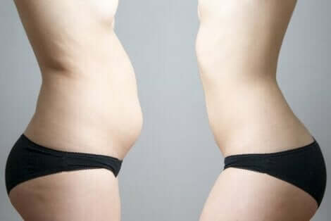 Man kan minska bukfettet med cryolipolysis.