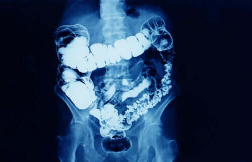 Röntgenbild på en förstoppad tarm.