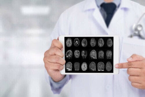 Läkemedlet madopar: läkare visar upp bilder på hjärna