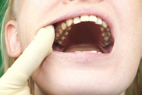 bakterier som orsakar karies: kvinna visar upp tänderna