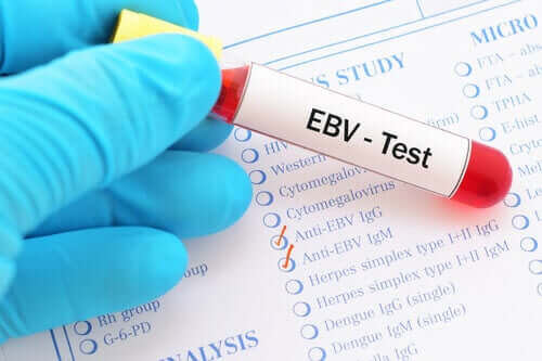 mononukleos smittsamt: blodprov för EBV