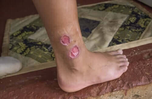 Sjukdomen leishmaniasis