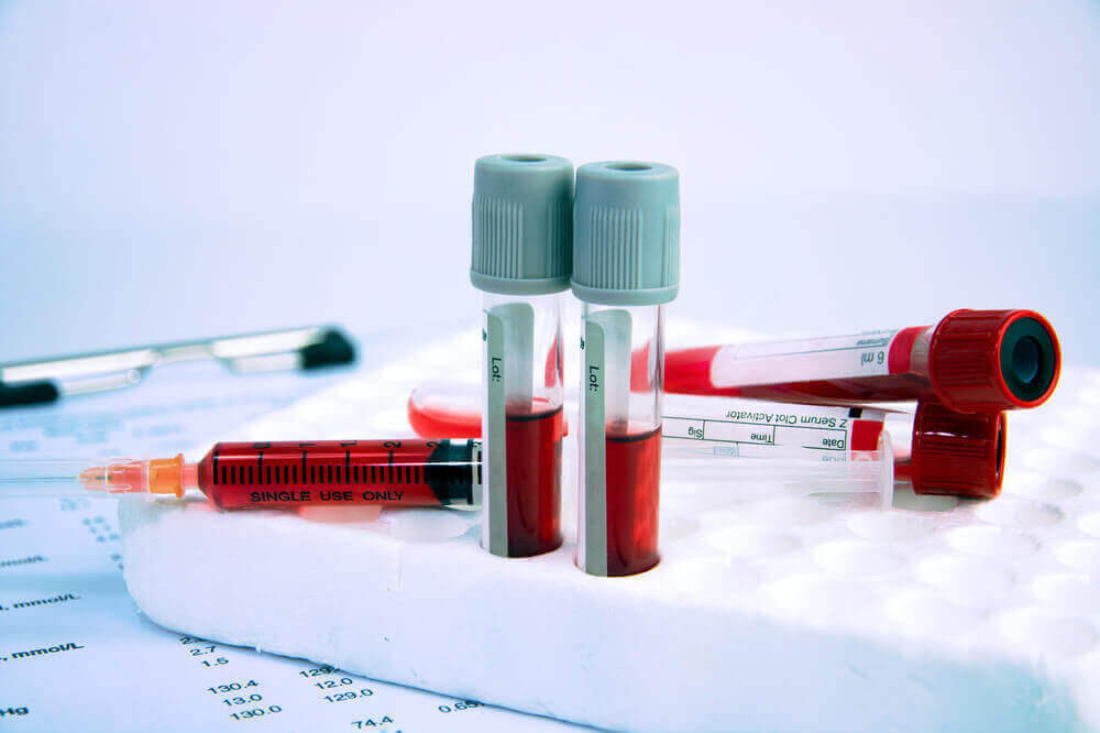 du är anemisk eller inte: blodprov