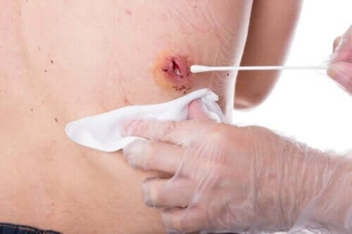 Snittdränering är ett av de första valen vid behandlingar av epidermala cystor.