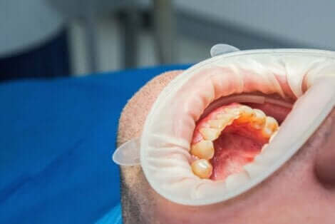 Överdriven användning av äppelcidervinäger kan leda till skador på tänderna