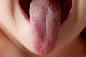 Är scharlakansfeber smittsamt?