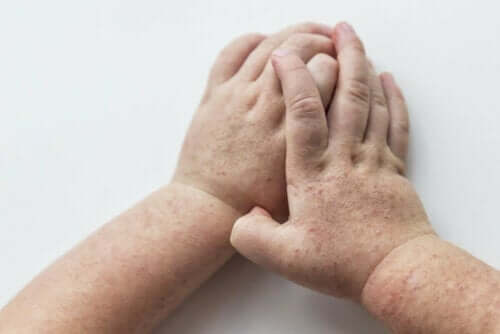 scharlakansfeber är smittsamt: barnhänder med utslag