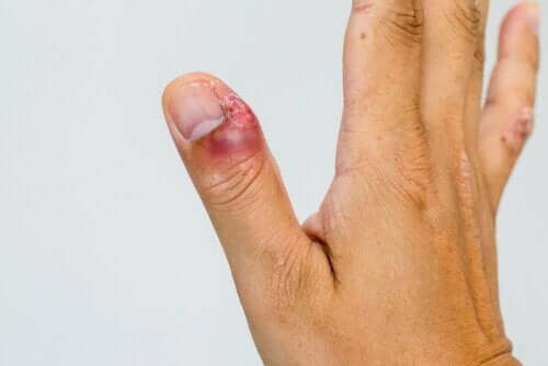infektioner i nagelbanden på tummen