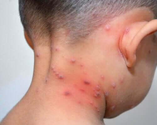 Barn med herpes zoster på nacken.
