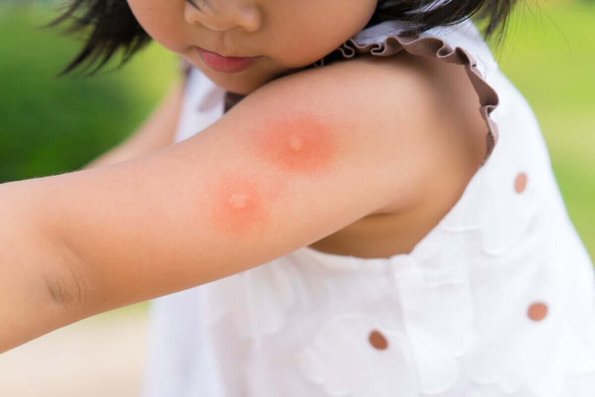 känna till om myggbett på barn
