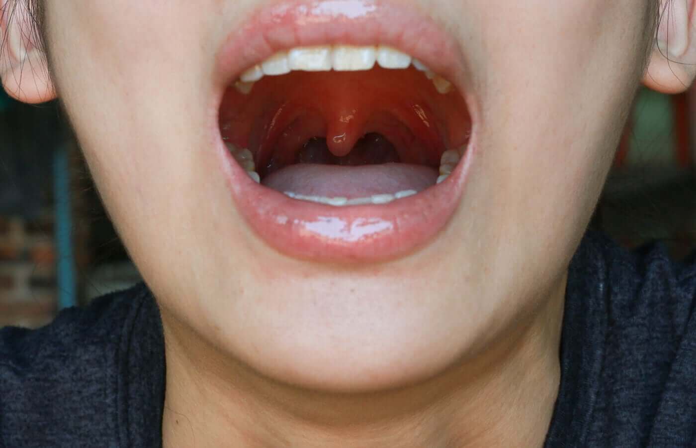 Inflammation i gomspenen
