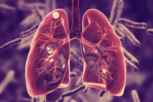 Tuberkulos i lungorna - vad är det?
