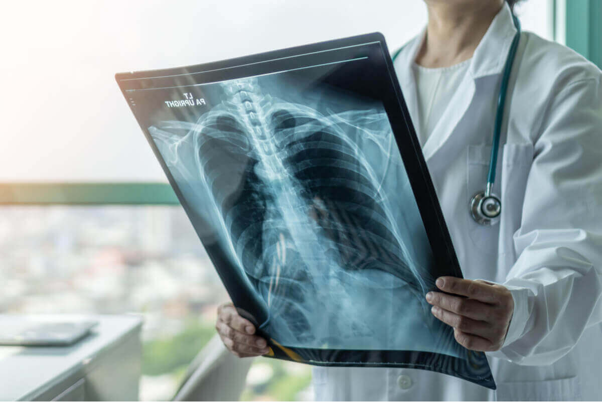 läkare tittar på röntgen med tuberkulos i lungorna