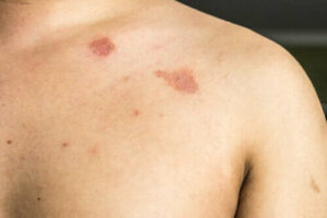 Beskrivning och egenskaper hos pityriasis versicolor