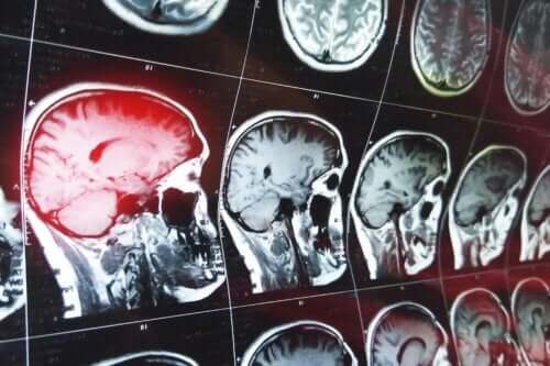 vad är konfabulationer: bilder på hjärna