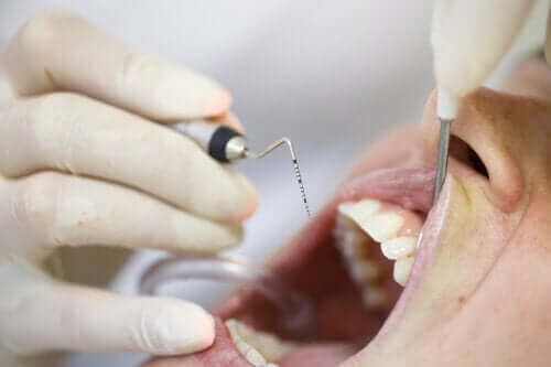 Periodontit: En problematisk sjukdom i tandköttet