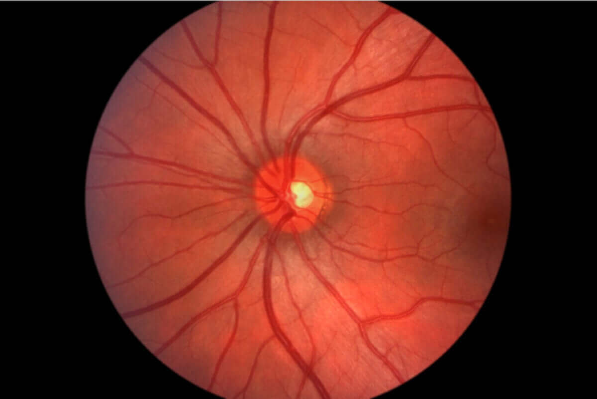 öga som är påverkat av Diabetiska ögonsjukdomar